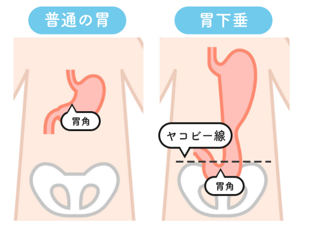 胃下垂の判断基準　胃下垂の確かめ方