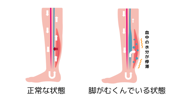 むくみ