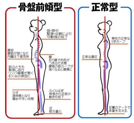 反り腰