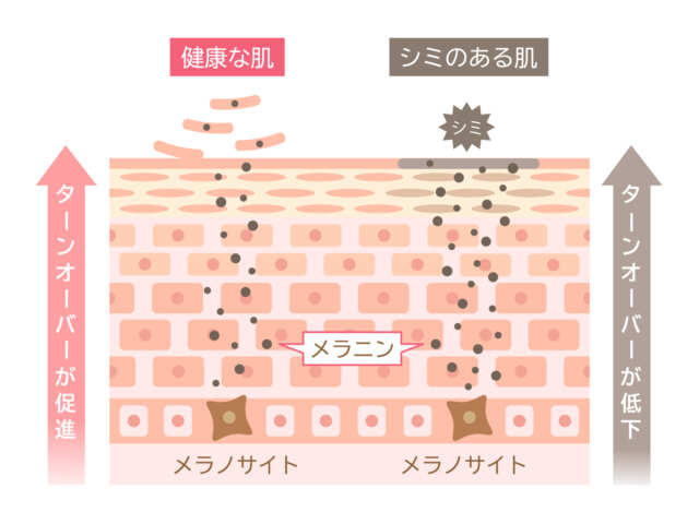 シミ