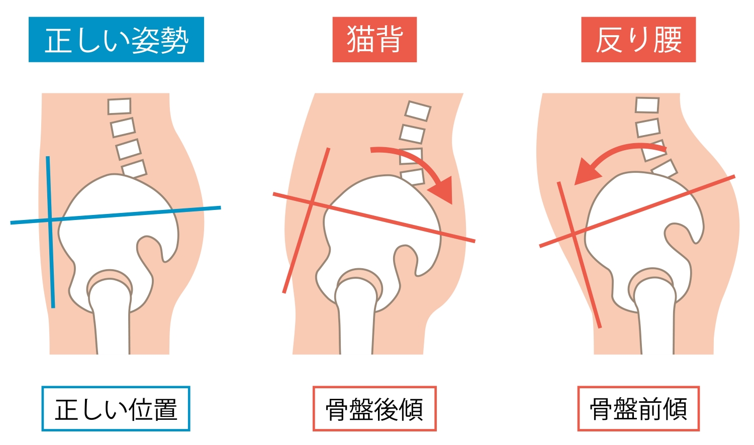 骨盤の後傾、前傾